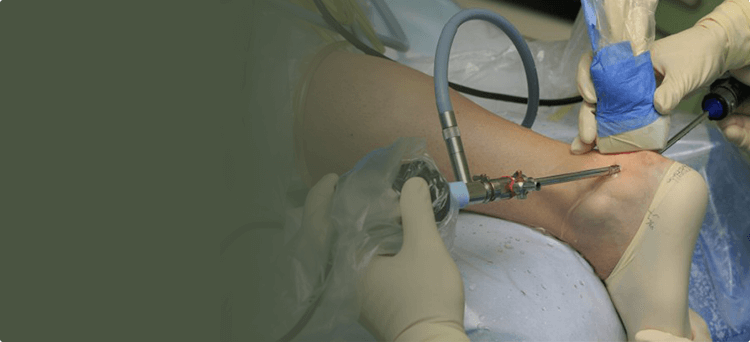 Артроскопия голеностопного сустава и суставов стопы
