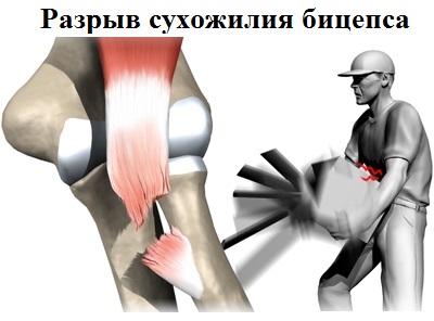 Обойтись разрыв. Отрыв дистального сухожилия бицепса. Вывих сухожилия двуглавой мышцы плеча. Повреждение сухожилия двуглавой мышцы плеча. Разрыв сухожилия двуглавой мышцы операция.