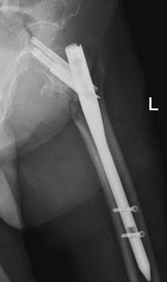 Удаление металлоконструкция при переломе плеча