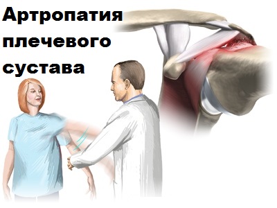 Артроз плечевого сустава ортопед
