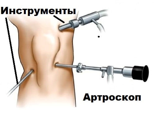 Киста коленного сустава лечение в москве