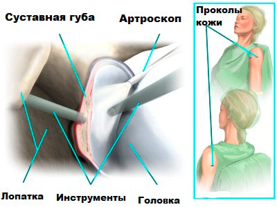 Лечение вывиха плечевого сустава операция