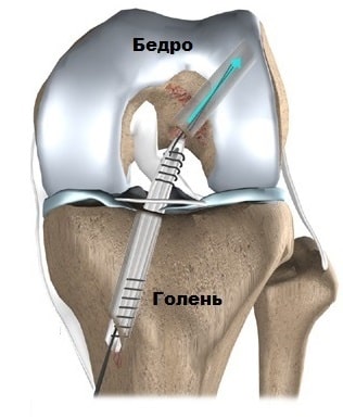 Повреждение задней крестообразной связки коленного сустава лечение