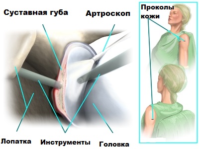 Операция банкарта плечевого сустава лечение