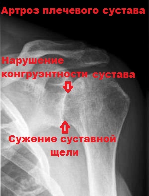 Артроз плечевого сустава ортопед