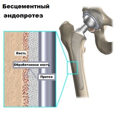 Перелом шейки бедра и коленного сустава