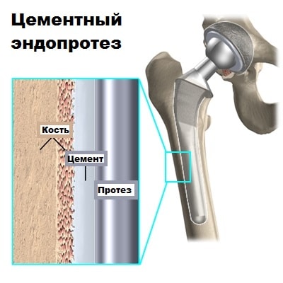 Методы оперативного лечения переломов шейки бедра