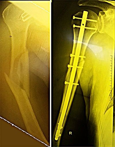 Перелом плечевой кости операция стоимость