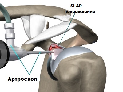 Плечевая губа суставная разрыв. Slap синдром плечевого сустава операция. Slap повреждение плечевого сустава операция. Повреждения суставной губы плечевого сустава slap. Слэп синдром плечевого сустава.