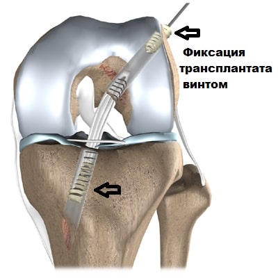 Задняя крестообразная связка коленного сустава лечение