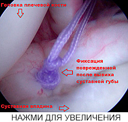 Операция банкарта плечевого сустава лечение thumbnail