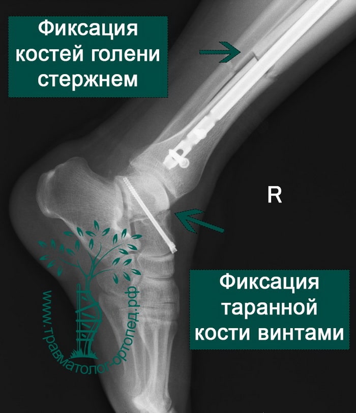 Оскольчатый перелом таранной кости лечение