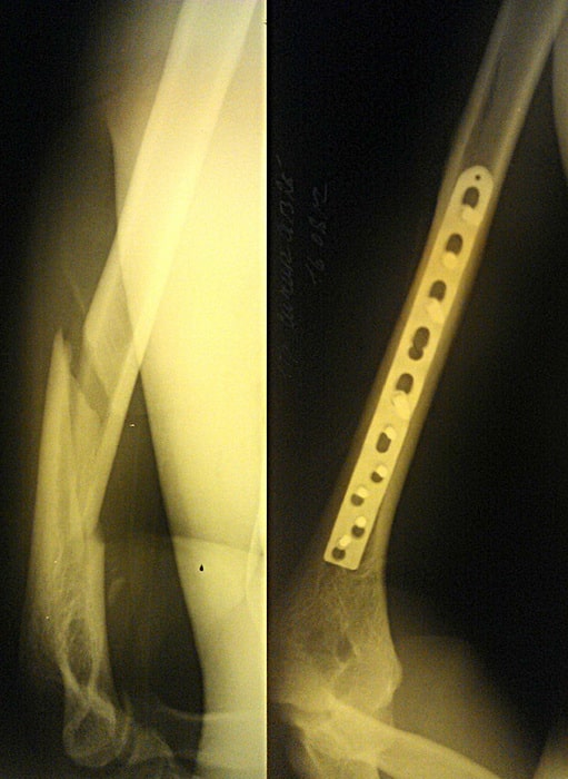 Операции при переломах плечевой кости видео
