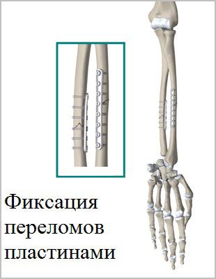 Показание к лечению при переломах костей предплечья