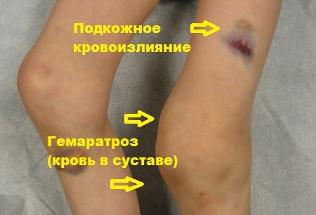 Травмы коллатеральных связок коленного сустава