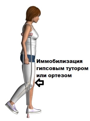 Разрыв связок коленный сустав медиальная лечение