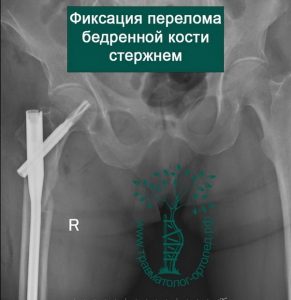 Мкб перелом бедренной. Подвертельный перелом бедренной кости. Подвертельный перелом бедра рентген. Чрезвертельный перелом бедра остеосинтез.