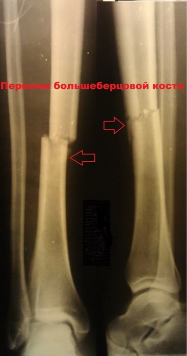 Стержень для ноги после перелома