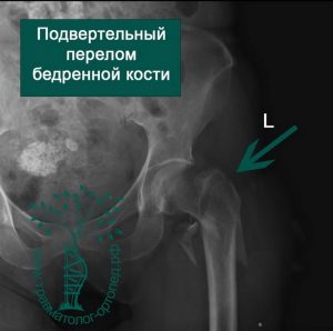 Подвертельный перелом. Подвертельный перелом шейки бедра. Подвертельный перелом бедренной кости операция. Чрезвертельный перелом бедренной кости кт. Оскольчатый подвертельный перелом бедренной кости.