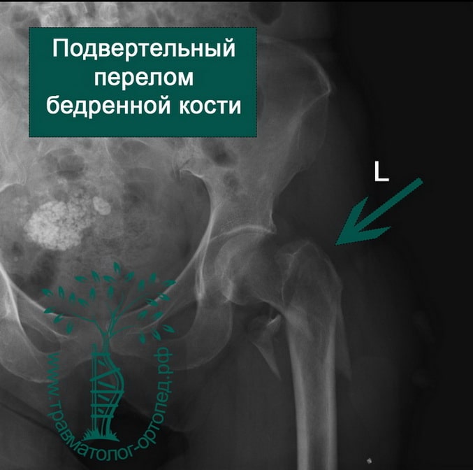 Подвертельный оскольчатый перелом бедренной кости
