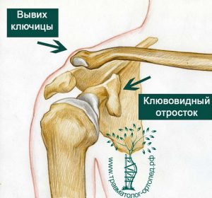 Малоинвазивная анатомическая реконструкция ключично-акромиального сочленения при