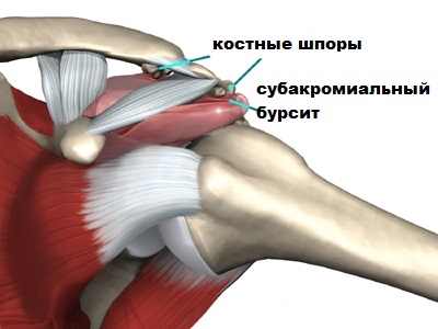 Лечение повреждений вращательной манжеты правого плечевого сустава