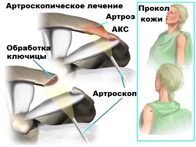 Артроз акромиально ключичный сустав операция