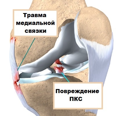 Внутренняя коллатеральная связка коленного сустава лечение