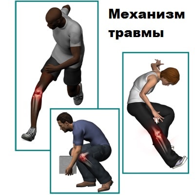 Лечение разрыва коллатеральных связок коленного сустава