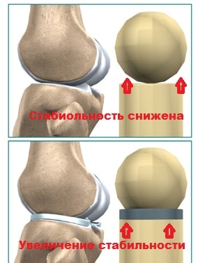Артроскопия мениска коленного сустава лечение
