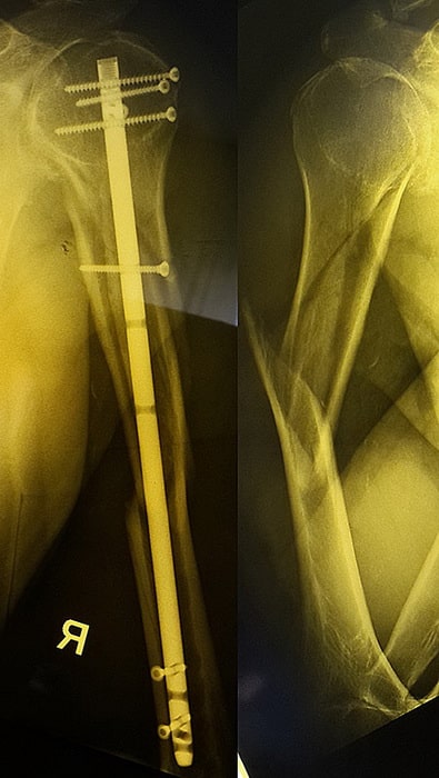 Перелом плечевой кости установка пластины