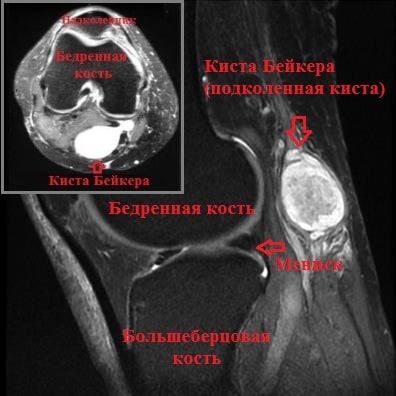 Лечение кисты бейкера коленного сустава в москве