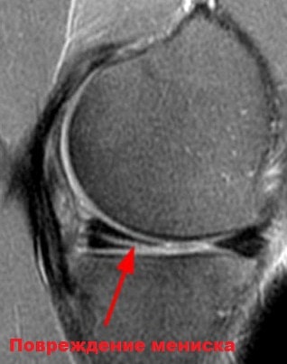 Какой врач лечит повреждение мениска коленного сустава thumbnail