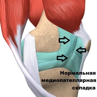 Синдром медиопателлярной складки коленного сустава из за чего thumbnail