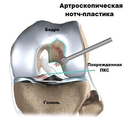 Разрыв передней крестообразной связки правого коленного сустава
