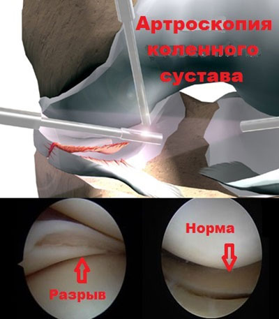 Повреждение мениска коленного сустава лечение в клиниках thumbnail