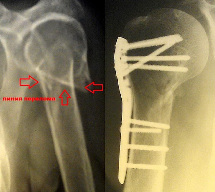 Операция по поводу перелома плечевой кости