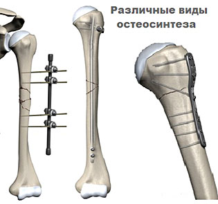 Правильное наложение гипса при переломе плечевой кости