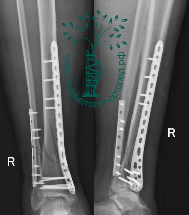 Установка стержня при переломе ноги