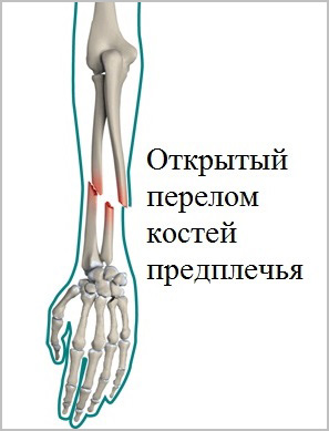 Перелом костей предплечья клиника лечение thumbnail