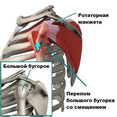 Адгезивный капсулит плечевого сустава лечение в москве