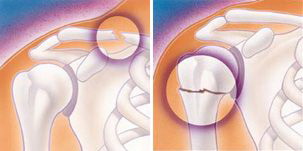 Перелом с вывихом плечевого сустава