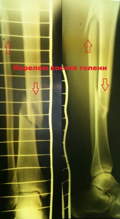 Сросшийся перелом ноги фото