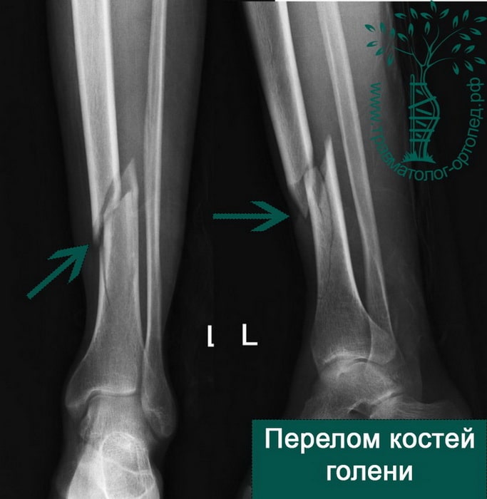 Установка стержня при переломе ноги