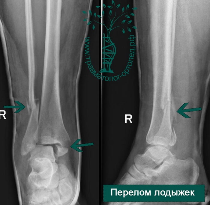 Перелом ноги лодыжки и стопы