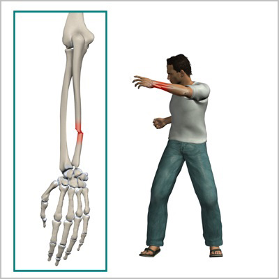 Показания к оперативному лечению при переломах костей предплечья