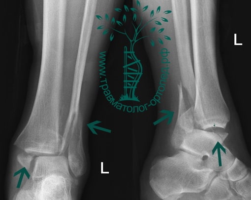 рентген ноги после перелома