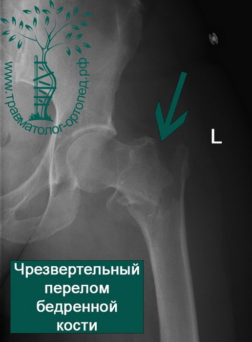 Подвертельный перелом со смещением левой бедренной кости