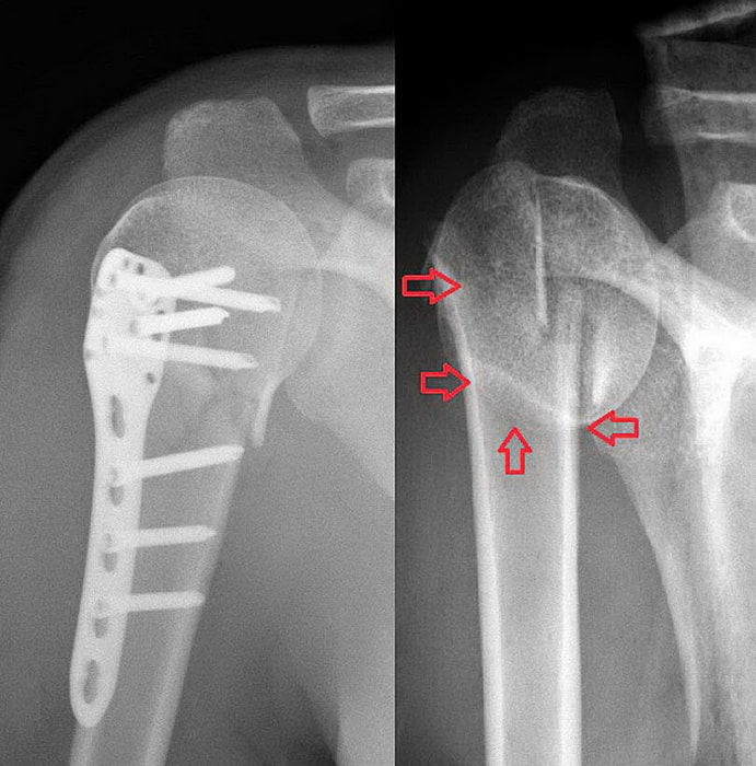 Операции при переломах плечевой кости видео