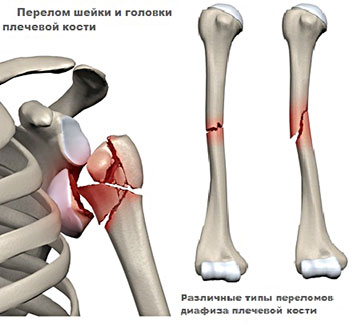 Перелом плечевой кости оперативное вмешательство